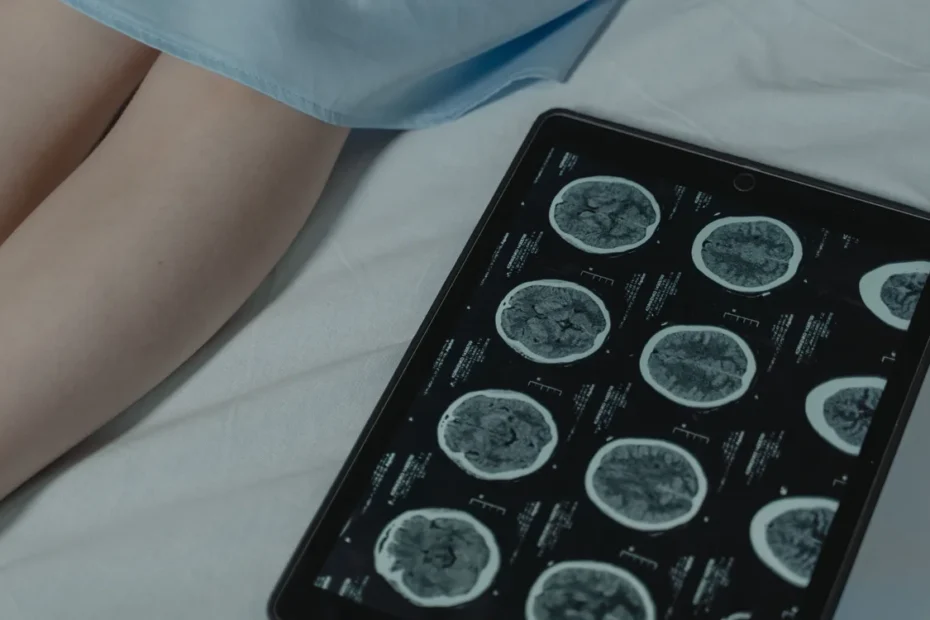 glioblastoma tumor cerebral ponto fraco