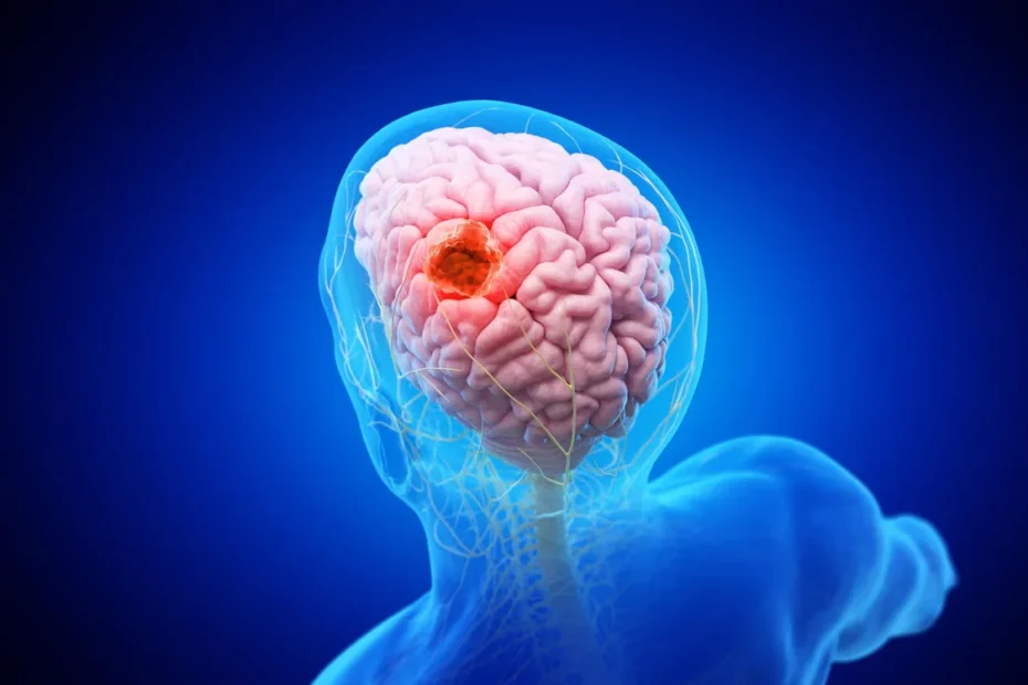 nanoparticle brain cancer